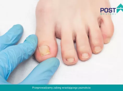 Chirurg Chorzów - usuwanie wrastającego paznokcia